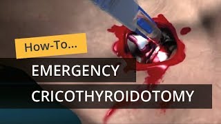 Emergency Cricothyroidotomy using CricKey [upl. by Gibe]