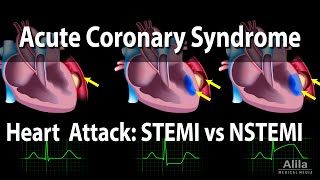 Acute Coronary Syndrome Unstable Angina NSTEMI and STEMI Heart Attack Animation [upl. by Ralph893]