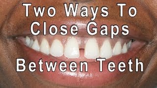 How to Close Gaps Between Teeth [upl. by Fantasia]