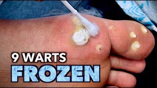 9 WARTS FROZEN on 1 FOOT with liquid nitrogen  Dr Paul [upl. by Taylor]