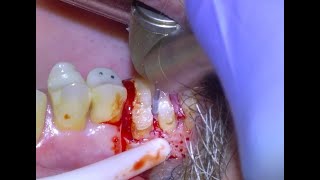 58 Surgical Molar Extraction [upl. by Zedekiah]