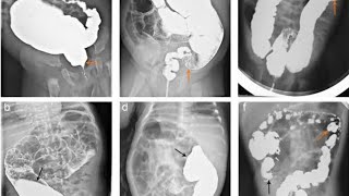 Barium Enema  Single and Double part 2 [upl. by Merrilee62]