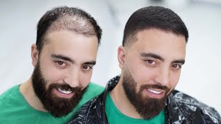 How Barber Transformed Thin amp Balding Hair with Hair Fibers [upl. by Rotman947]