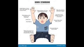 MEOTIC ERRORS  NON DISJUNCTION OF CHROMOSOMES  DOWN SYNDROME  KLINEFILTER SYNDROME  TURNER SYNDR [upl. by Ennayk]