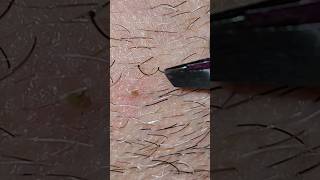 Ingrown Beard Hair [upl. by Markland]