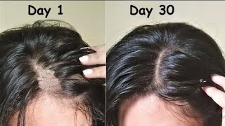 Hair growth transformationRegrow my short thin hair to thick healthy hairRegrow your hair in 1day😳 [upl. by Vasileior]