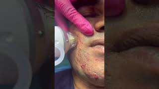 Microneedling radiofrequency treatment in combination with fractional co2 laser for pimple scars [upl. by Frymire]