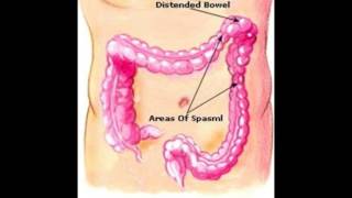 What is the Splenic Flexure [upl. by Idnib]