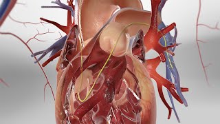 Pulmonary Artery Catheterization 3D Animation [upl. by Arabella]