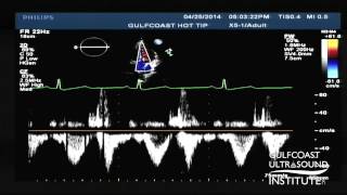 Hot Tips  Calculating the Aortic Valve Area Using the Continuity Equation [upl. by Philipp75]