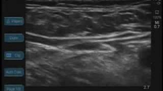 Femoral Nerve Ultrasound [upl. by Gottlieb978]