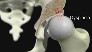 Acetabular Dysplasia [upl. by Neirbo623]