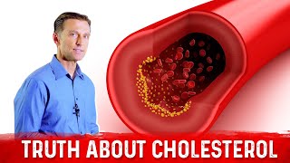 The Truth About Cholesterol – LDL Cholesterol amp HDL Cholesterol – DrBerg [upl. by Mokas]