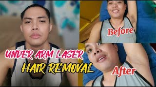 FIRST TIME UNDER ARM LASER HAIR REMOVAL BY INDAY GERALD [upl. by Llerad572]