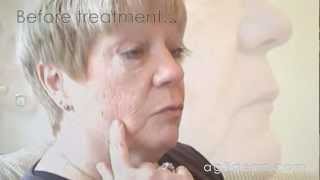 Ann Ag3derm  Age Spot amp Keratosis [upl. by Niggem]