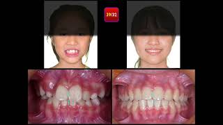 Molar Ankylosis｜【Chris Chang Ortho】CC796 [upl. by Petuu]