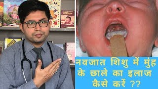 Oral candidiasis  Oral white patch  How to manage Oral thrush in baby  how to clean baby mouth [upl. by Shult]