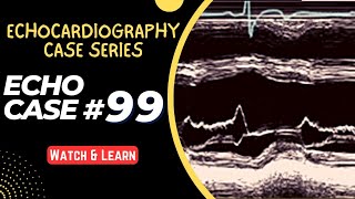 ECHO CASE 99  Echocardiography for Beginners  M Mode Echocardiogram [upl. by Eisak44]