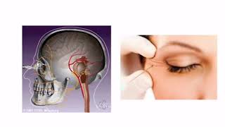 Hemifacial Spasm with Dr Dong Kim [upl. by Pomeroy415]