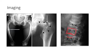 Osteomalacia and Rickets [upl. by Thibaut383]