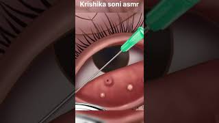 ASMR eye stone removal animation  Eyelid Sebum Extrusion Animation  Meibomian Gland Cleaning [upl. by Airamanna]