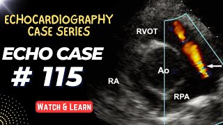 ECHO CASE 115  Echocardiography Spot Diagnosis Case Series [upl. by Ambrosine]