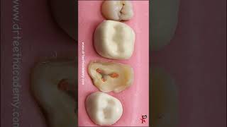 Last Hope of Saving this Tooth dentalcavity dentist [upl. by Jessi]