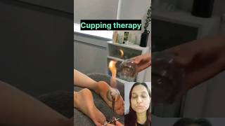 CUPPING THERAPY PLANTAR FASCITIS MEDICAL NEETPG SHORTS [upl. by Eiznikcm]