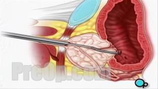 TURP Transurethral Resection Prostate Surgery patient education series [upl. by Tamsky]