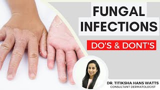 Fungal infection of skin  Dos and Donts  फ़ंगल इन्फ़ेक्शन से बचने के उपाय  Healing Hospital [upl. by Enyrehtak]