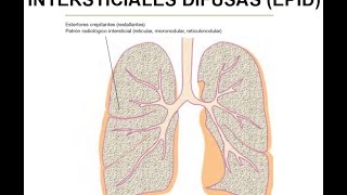 FISIOPATOLOGÍA RESPIRATORIA Enfermedades pulmonares intersticiales difusas EPID [upl. by Enimzaj283]