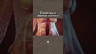 É assim que acontece a diástase abdominal 🫣 [upl. by Gilchrist404]