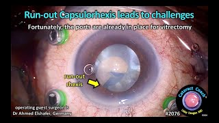 CataractCoach™ 2076 runout capsulorhexis leads to challenges [upl. by Nealon]