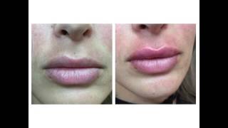 Juvederm Lips by Anusha in West LA [upl. by Artap]