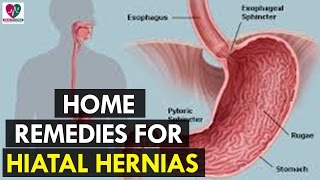 Home Remedies for Hiatal Hernias  Health Sutra [upl. by Reynolds]