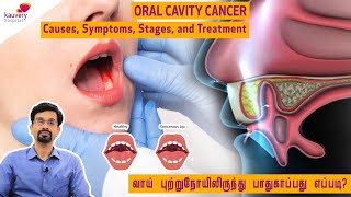 Oral Cavity Cancer  Causes Symptoms Stages and Treatment [upl. by Aeiram]