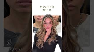 Masseter botox [upl. by Hedda12]