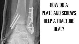 How does a plate and screws help a broken bone heal [upl. by Syverson617]