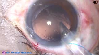 Management of posterior extension of Rhexis runout  3092018 P Mohanta [upl. by Danna]