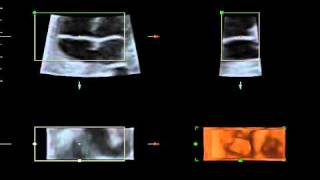 Válvulas tricuspide y mitral en un feto de 29 semanas [upl. by Ademla]