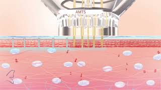 Introducing EPN Plus Microneedling with Electroporation [upl. by Eak913]