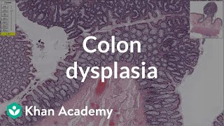 Colon dysplasia  Gastrointestinal system diseases  Health amp Medicine  Khan Academy [upl. by Adaurd]