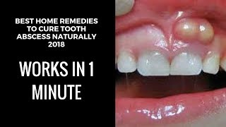 how to drain a tooth abscess at home home remedies for tooth abscesstooth abscess pain relief fast [upl. by Nichol]