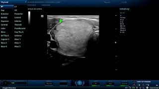 4th tirads score thyroid nodule Diagnostic ultrasound cases [upl. by Leong]