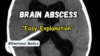 Brain abscess  CNS pathology  Robbins  emotionalmedico [upl. by Savick]