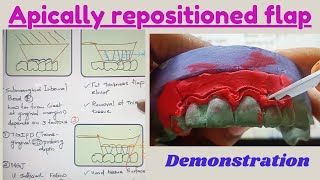 Any dentists can easily learn apically repositioned flap amp bevelled flap with this cast demo [upl. by Burrton]