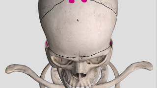 Bifrontal decompressive craniectomy bony cuts [upl. by Fairlie127]