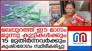 മൂന്നു കുട്ടികള്‍ക്കും15 മുതിര്‍ന്നവര്‍ക്കും കുഷ്ഠരോഗം സ്ഥിരീകരിച്ചു I Leprosy [upl. by Naux]