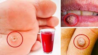 I Used This Juice And My Warts Disappeared [upl. by Leimad]