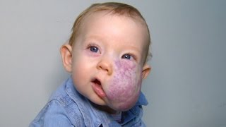 See 2YearOlds Incredible Transformation After Surgery To Remove Facial Tumor [upl. by Orford]